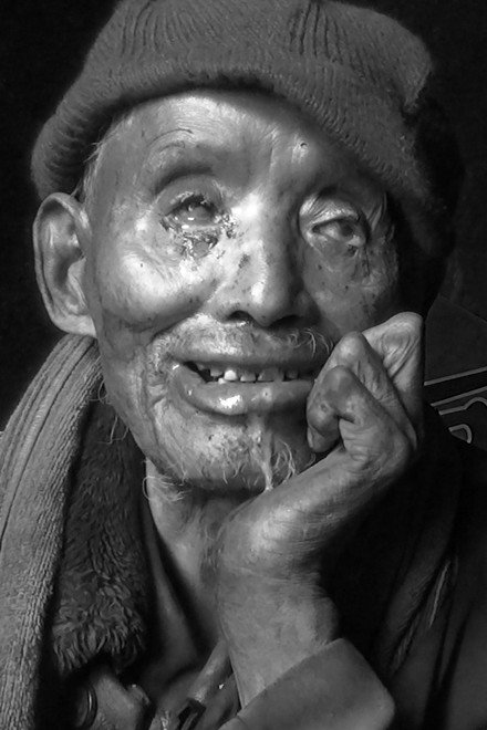 Blessing of Leprosy